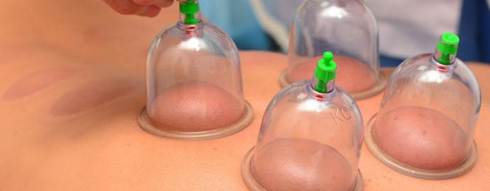 Cupping Treatment